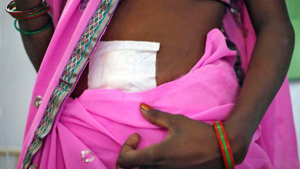 கருப்பை நீக்கம் கருப்பை நீக்கம்