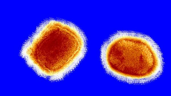  கேரளாவில் குரங்கு அம்மை பாதிப்பு 