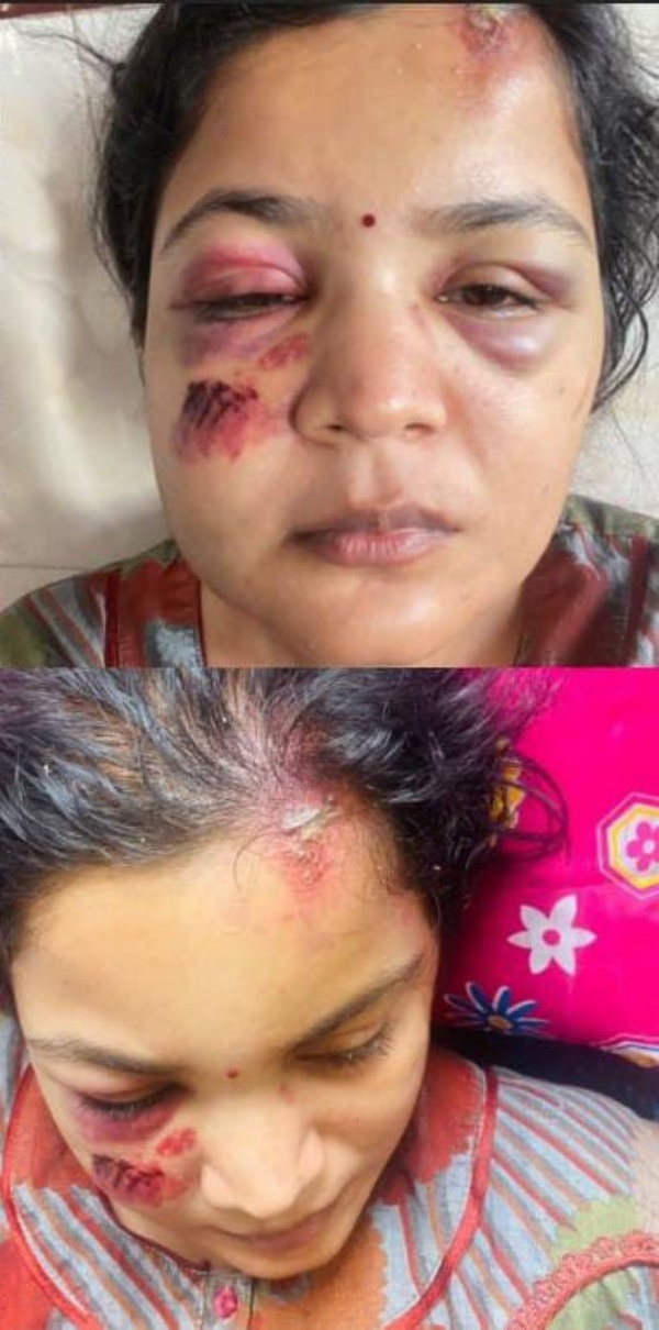  முகம் முழுவதும் காயம் 