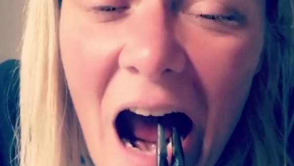 பற்கள் அகற்றம் 