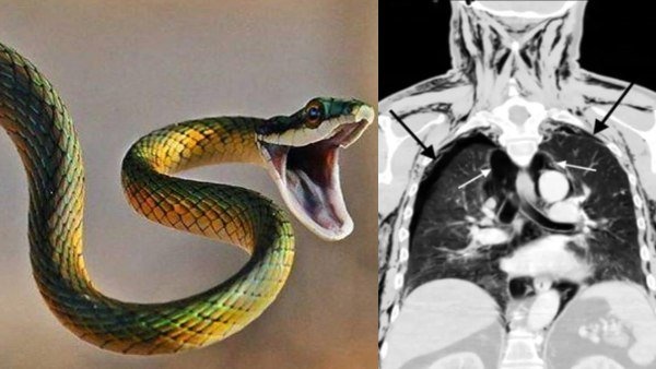 விதைப் பைகளில் அறுவை சிகிச்சை 