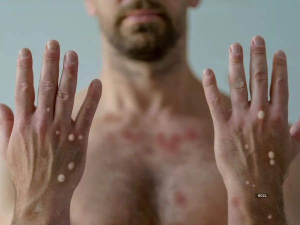 குரங்கு அம்மை - ஆய்வு மையம்