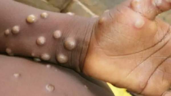 வேகமாக பரவி வரும் குரங்கு அம்மை