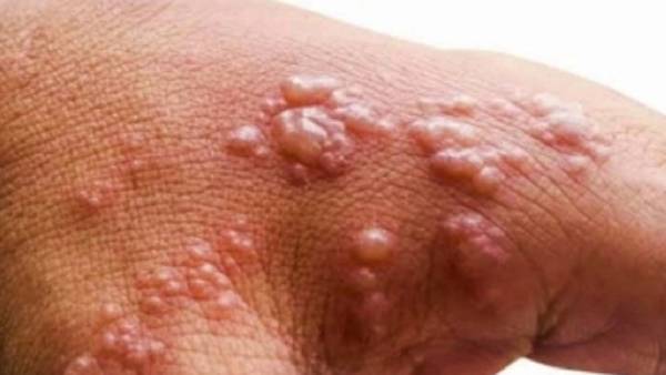  மங்கி பாக்ஸ்