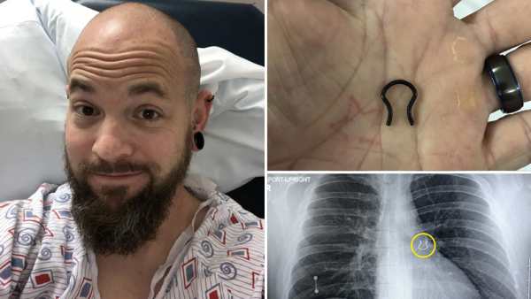 நுரையீரலில்'நோஸ் ரிங்' நுரையீரலில்'நோஸ் ரிங்'