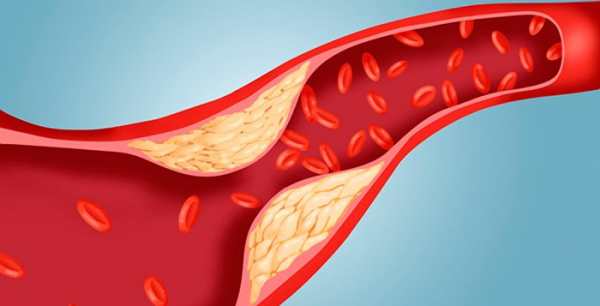 கெட்ட கொழுப்பு 