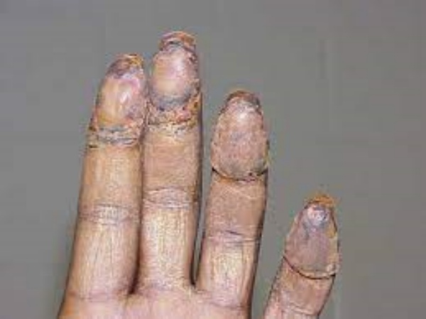 கைரேகையை மாற்ற அறுவை சிகிச்சை