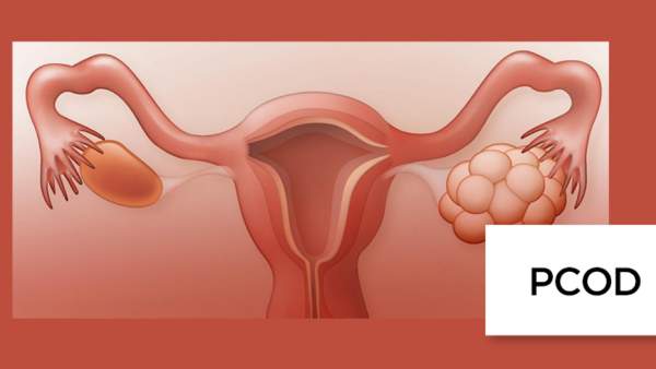 PCOD என்றால் என்ன? PCOD என்றால் என்ன?