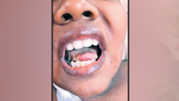 வெந்த நாக்கு வெந்த நாக்கு