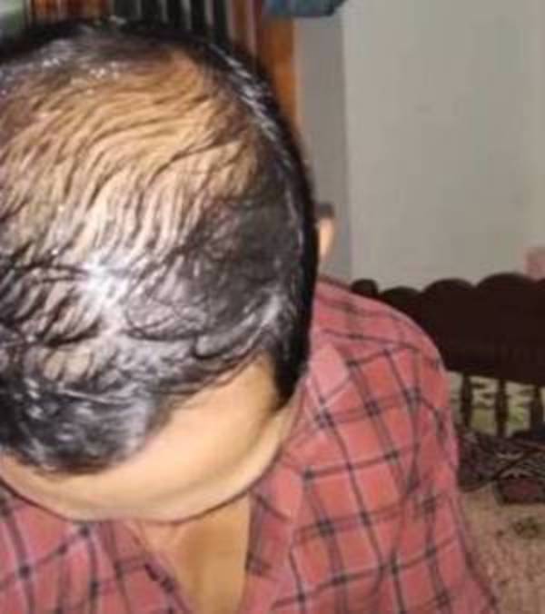 தலைமுடி உதிர்வு 