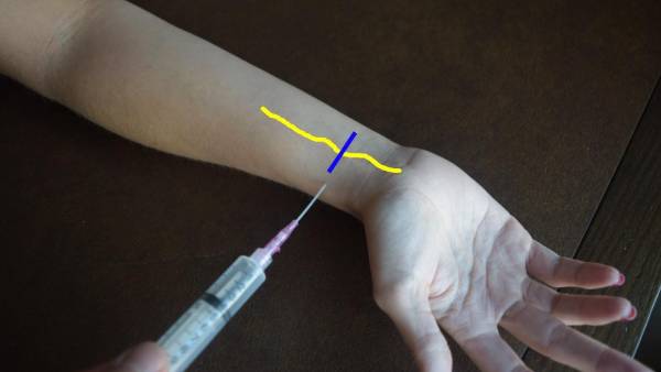 ரணம் நிறைந்த நரம்பு ஊசி.. 