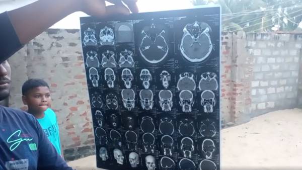 90% பார்வை போய்விட்டது 