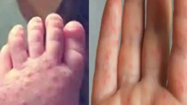 தலை முதல் கால் வரை தக்காளி வைரஸ்