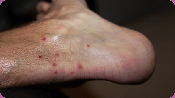 மோசமான தொற்று