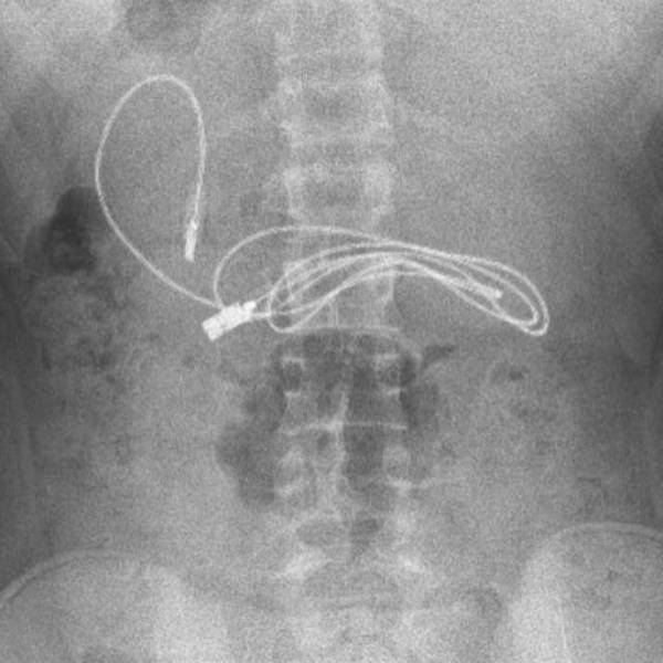 வயிற்றுக்குள் 3 அடி நீள சார்ஜர் 