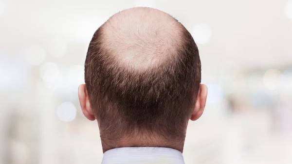 வழுக்கை தலை வழுக்கை தலை