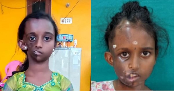 முக சிதைவு நோய் முக சிதைவு நோய்