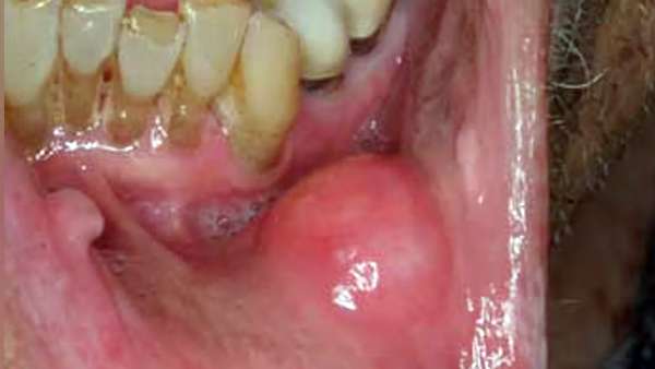 8. ரத்த புற்றுநோய்கள் 