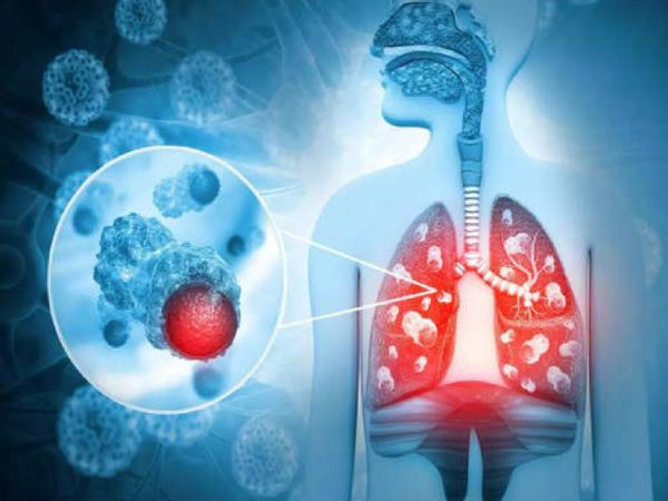  1. நுரையீரல் புற்று நோய் 