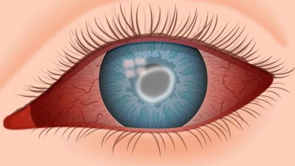 காணாமல் போன கருவிழி காணாமல் போன கருவிழி