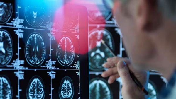  அல்சைமர் 