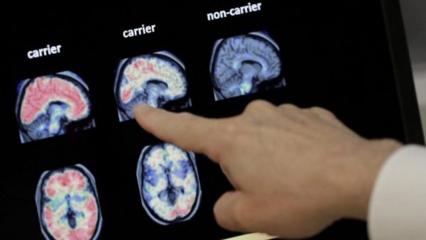  அல்சைமர் அறிகுறிகள்