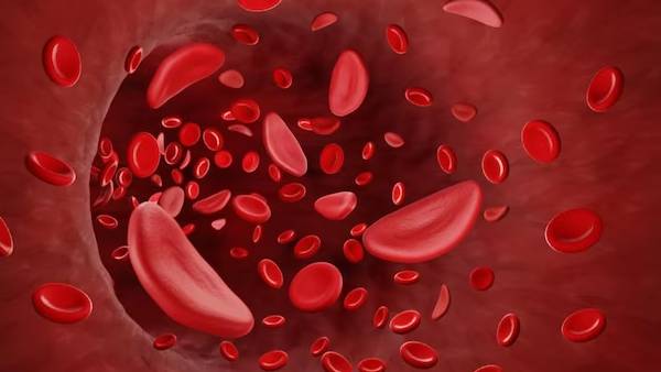 சிக்கிள் செல் அனிமீயா 