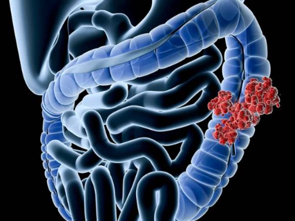  பெருங்குடல் புற்றுநோய்