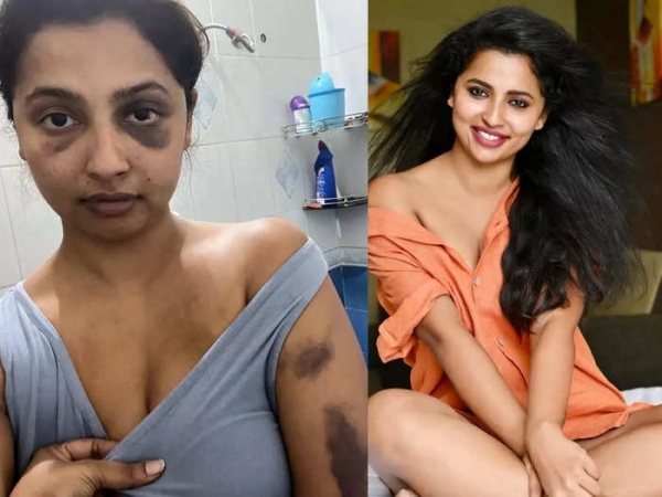 உடலில் காயங்கள் 