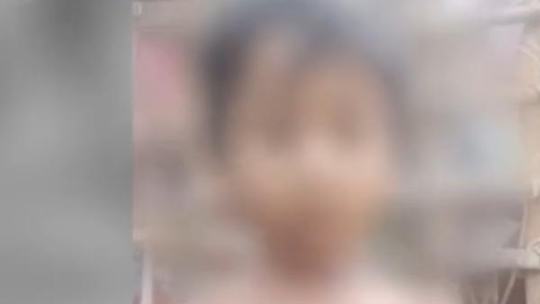  முதல் அறுவை சிகிச்சை 