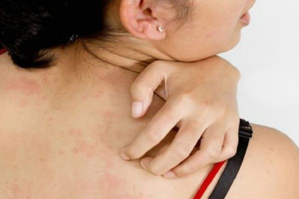  வியர்க்குரு 