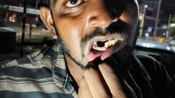  வாயில் ஜல்லிக் கற்களை திணித்து 