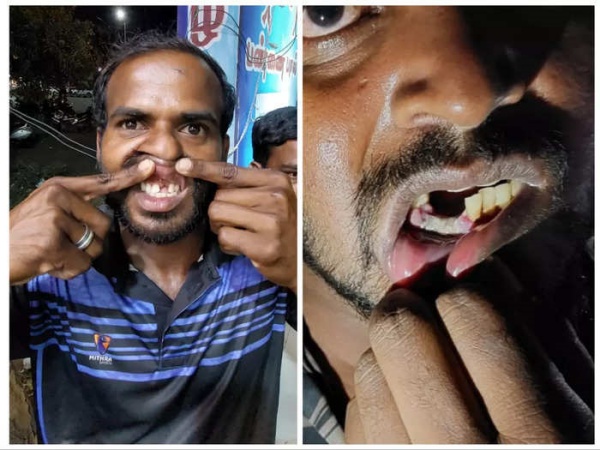 ஜல்லிக் கற்கள் 