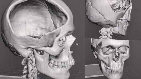 Chennai Kilpakkam Government hospital big Achievement in Neuroplastic Surgery with Artificial Skull in 3D Technology 