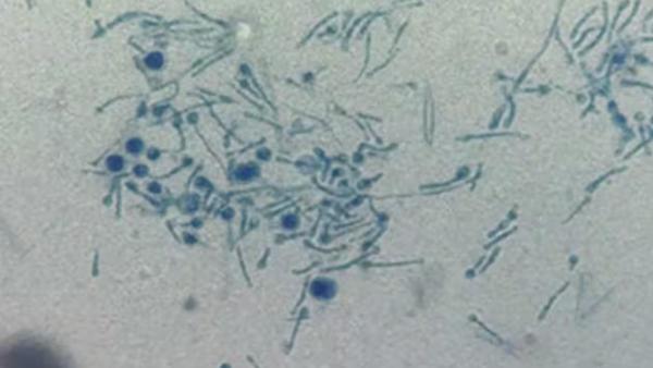  கில்லர் பூஞ்சை 