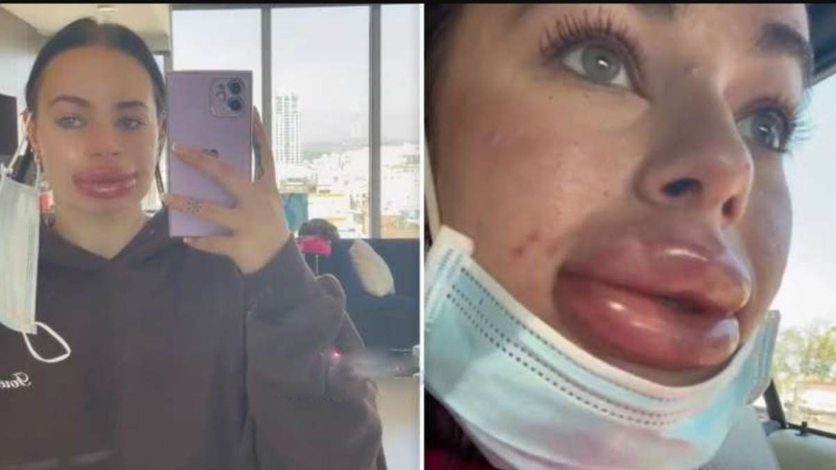 A Social media influncer gets traumatic experience after getting lip filler treatment A Social media influncer gets traumatic experience after getting lip filler treatment