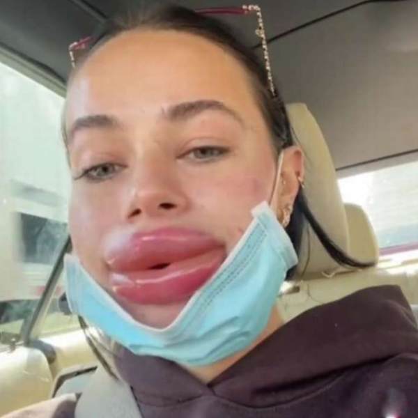 A Social media influncer gets traumatic experience after getting lip filler treatment A Social media influncer gets traumatic experience after getting lip filler treatment