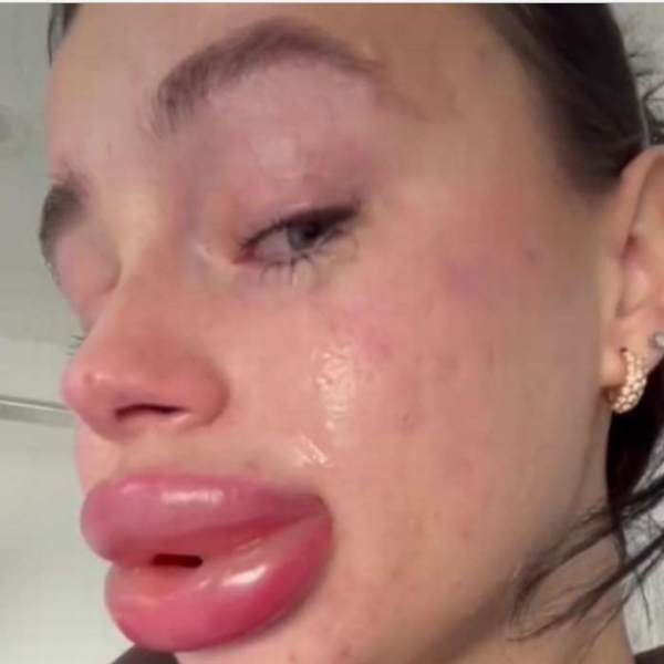 A Social media influncer gets traumatic experience after getting lip filler treatment A Social media influncer gets traumatic experience after getting lip filler treatment