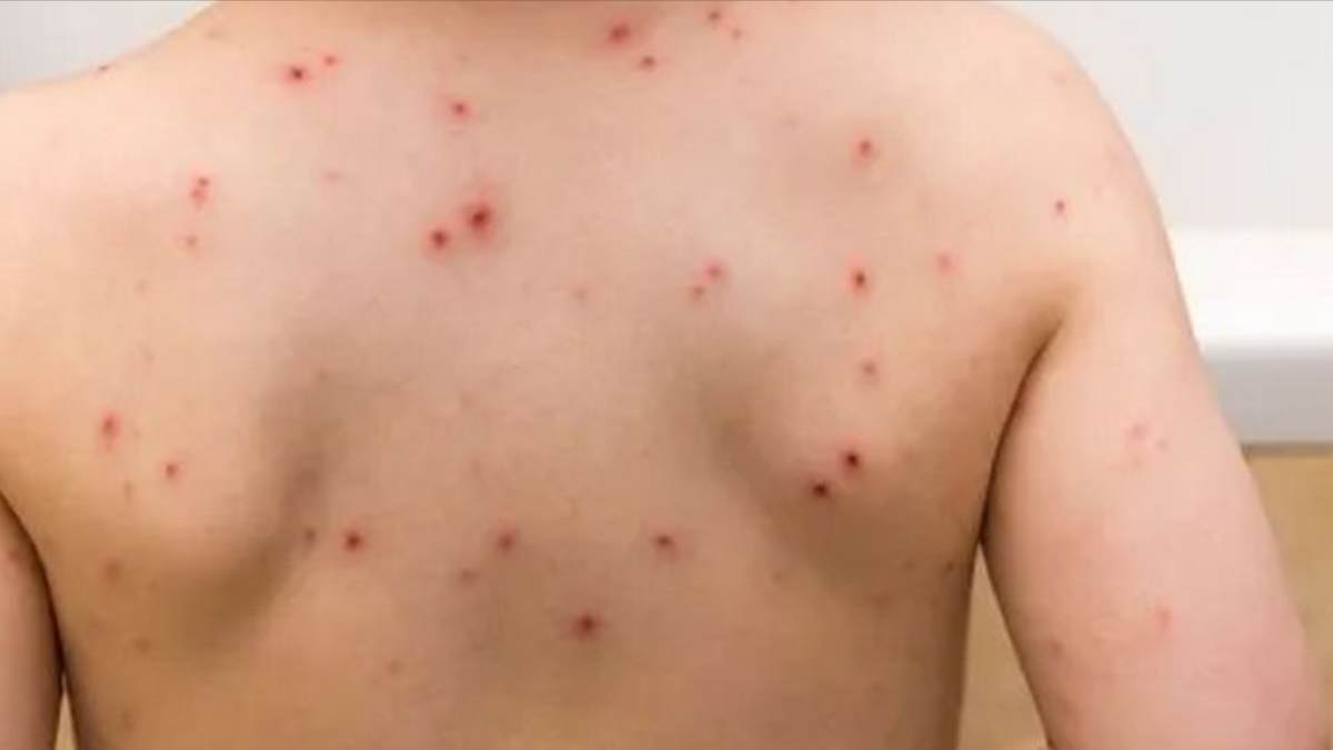 What causes measles during hot season? How to prevent it?
