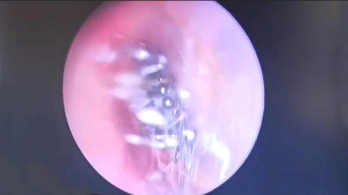 Spider Nesting web inside a ear was discovered when the doctor performed an endoscopy for woman 