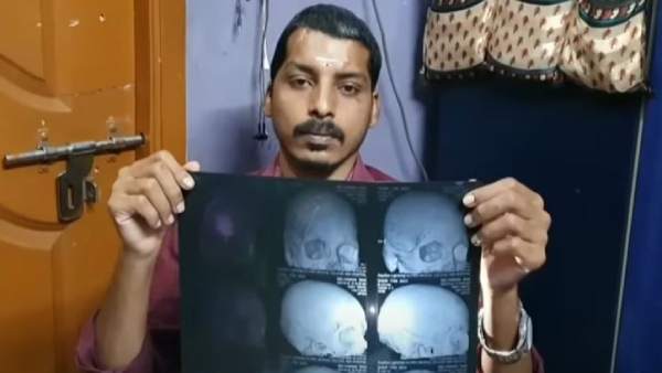  Using 3D technology, govt. hospital doctors in Chennai restore contour of skull in 29-year-old man