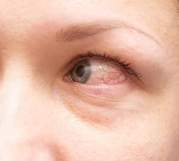 Major and main instructions about eye allergy in summer, whats happening in chennai 