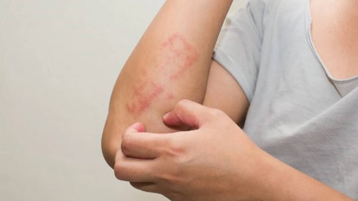 Health News: Simple ways to get rid of skin damage during summer season 