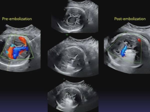 Doctors performed Worlds first ever brain surgery for 34 weeks foetus 