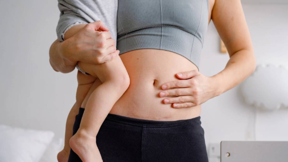 Cesarean delivery: Simple Tips For A Speedy Recovery 