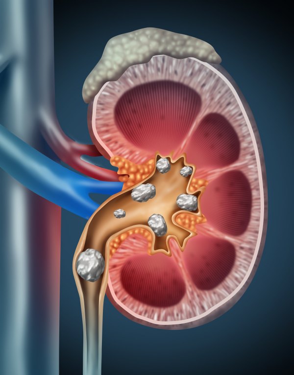 Kidney stones that are annoying in summer! What is the way to dissolve it without surgery? 