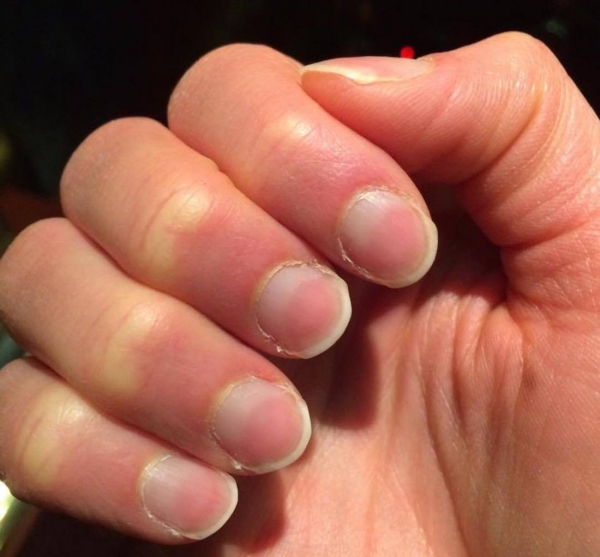  Why do nails change color? what are the symptoms?