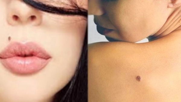 health news and Do you know how to remove the moles and general information about the moles health news and Do you know how to remove the moles and general information about the moles