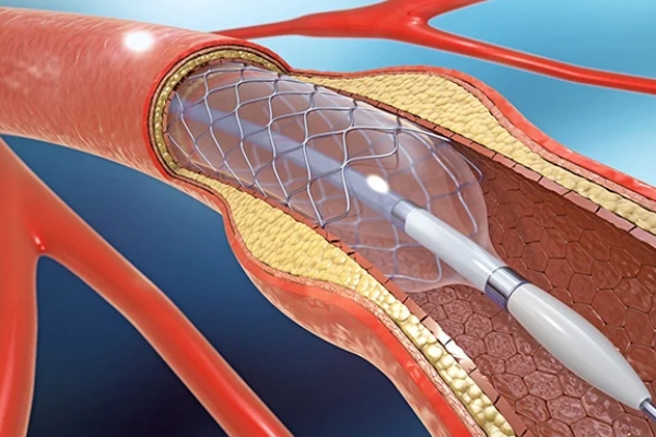 Dr Farook explains about whether one who puts stent in their heart should not eat mutton? Dr Farook explains about whether one who puts stent in their heart should not eat mutton?