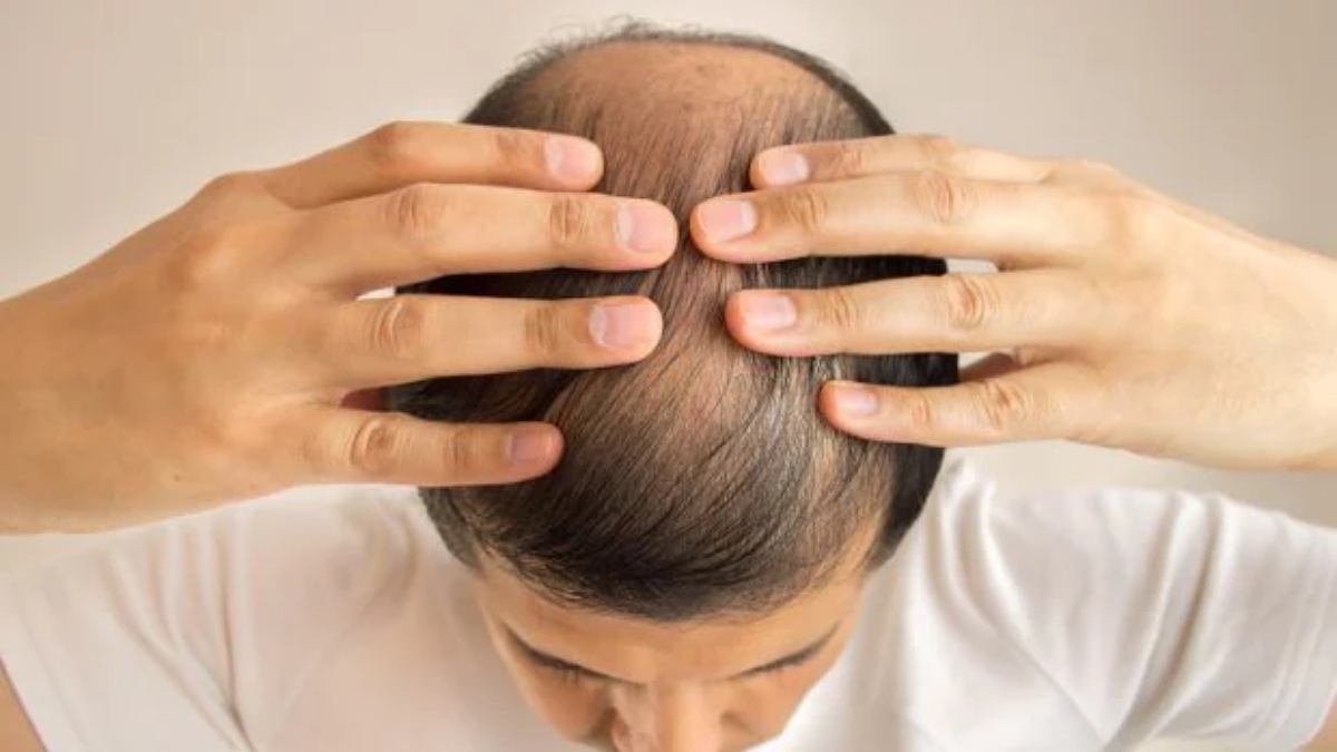 What is the Reason for baldness for Men?..Here is Simple Home Remedy What is the Reason for baldness for Men?..Here is Simple Home Remedy